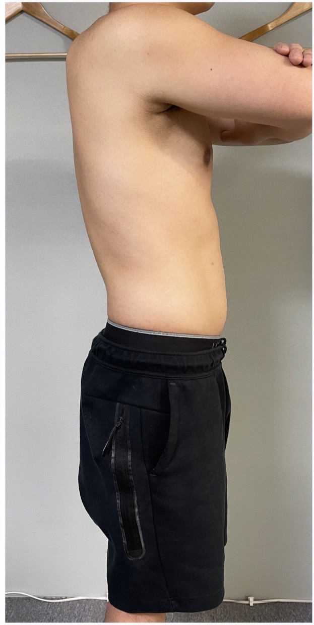 After: 反り腰改善・ダイエット