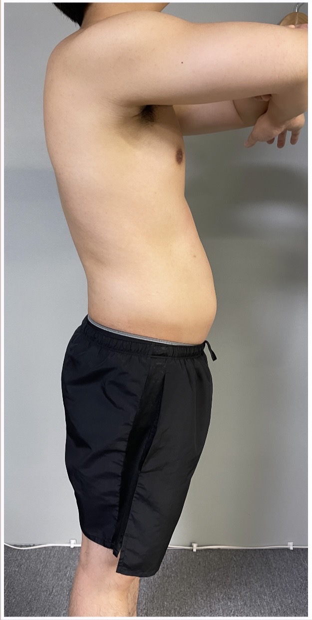 Before: 反り腰改善・ダイエット